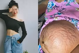 Đặng Thu Thảo bầu đôi bụng rạn chi chít, loạt sao chung cảnh ngộ