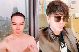 Nathan Lee trông thế nào sau khi phẫu thuật vùng đầu?