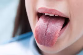 Lưỡi có thể tiết lộ tình trạng sức khỏe đang gặp vấn đề gì? 