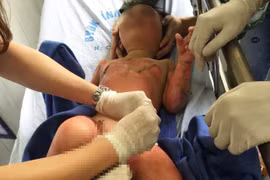 Giáo viên đổ cồn châm lửa để dạy kỹ năng làm 3 bé bỏng nặng: Trách nhiệm của ai?
