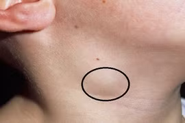 Có những dấu hiệu này, mau đến bệnh viện kiểm tra kẻo ung thư hạch