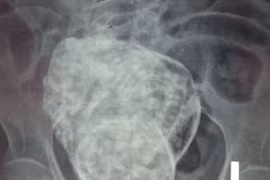 Hy hữu cụ bà 76 tuổi mang thai suốt 30 năm