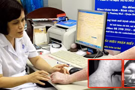 Mặt biến dạng vì kem rởm