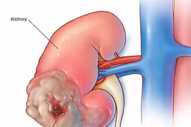 6 triệu chứng ung thư thận nhiều người bỏ qua