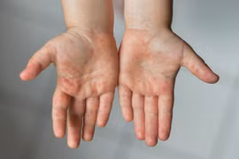 Gallery - BỆNH ĐẬU MÙA KHỈ - image 6