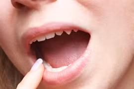 Nguy cơ bị ung thư lưỡi với 3 dấu hiệu bất thường ở miệng