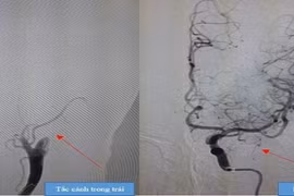 Bất ngờ bị đột quỵ khi đang ăn cơm trưa