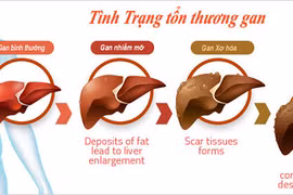 Gallery - Bệnh Máu Nhiễm Mỡ - image 6