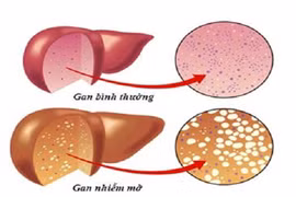 Gallery - Bệnh Máu Nhiễm Mỡ - image 9