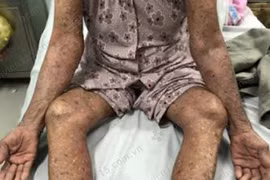 Tự ý dùng thuốc trị gout, cụ bà 83 tuổi nổi phỏng đỏ toàn thân