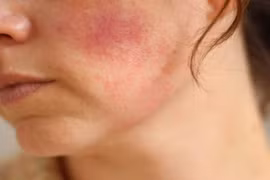 Nhận biết da bị kích ứng do mỹ phẩm