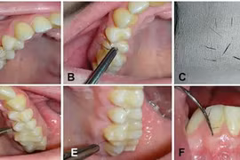 Cô gái 25 tuổi mọc lông ở nướu răng, bác sĩ sửng sốt