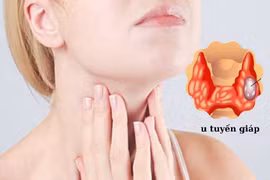 70% người ung thư tuyến giáp có bố, mẹ, anh chị em từng mắc 
