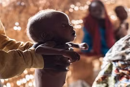 Loạt ảnh gây sốc về những đứa trẻ suy dinh dưỡng ở Nigeria