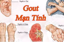 Gallery - Phòng Chống Bệnh Gout - image 16