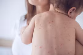  5 bệnh trẻ dễ mắc trong mùa hè và cách phòng ngừa