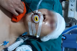 Bắt nhóm đối tượng đánh nam sinh chấn thương sọ não trước cửa nhà