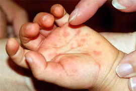Bộ Y tế khuyến cáo phòng bệnh viêm não virus và chân tay miệng 