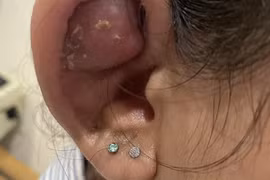Xỏ khuyên làm đẹp, thiếu nữ bị tai biến viêm sụn vành tai