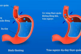 Bác sĩ mách cách tránh trào ngược dạ dày - thực quản trong và sau Tết