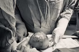 Kịp thời cứu sống mẹ con sản phụ mắc cùng lúc nhiều bệnh nguy hiểm