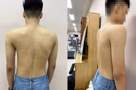 Khám sàng lọc, chẩn đoán hình ảnh miễn phí bệnh gù, vẹo cột sống trẻ em