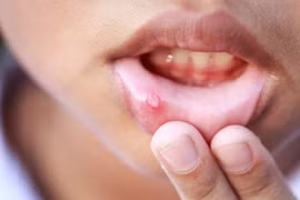 Những thói quen số một gây ung thư miệng