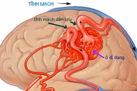 Mắc bệnh này, bạn có nguy cơ đột tử trước tuổi 40