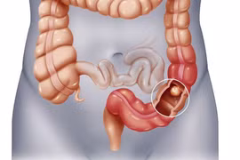 Tắc ruột do yếu tố thần kinh 