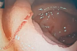 Suy kiệt vì giun mỏ lúc nhúc đâm thủng ruột non