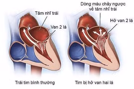 Sự khác nhau giữa hở và hẹp van hai lá