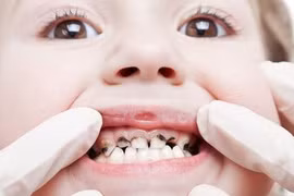 Đông y chữa bệnh cam răng