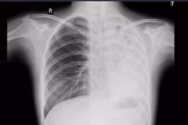 Hình ảnh phim chụp của bệnh nhân lao nội mạc phế quản