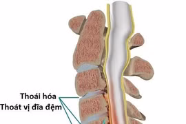 Hẹp ống sống cổ, kẻ thù thầm lặng đầy nguy hiểm