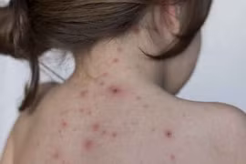 Cẩn thận biến chứng thủy đậu có thể gây tử vong