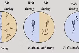 Tinh trùng dị dạng và bất động 90%