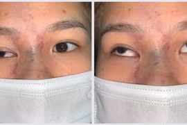 Cô gái 17 tuổi tắc hoàn toàn động mạch mắt phải sau tiêm filler tại Spa