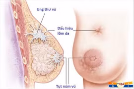 Sarcom xơ và sarcom mô bào xơ