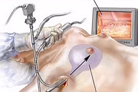 Đặt túi ngực sau lấy bỏ nhân xơ