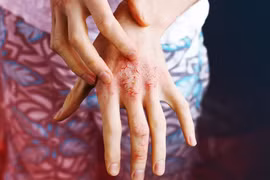 Người bệnh vảy nến cần tầm soát bệnh trước khi sử dụng thuốc sinh học