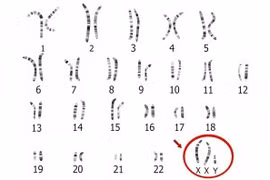 Đột biến gene hiếm gặp gây hiếm muộn 