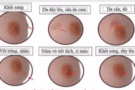 U vú tái phát, di căn vì mổ không đúng chuyên khoa