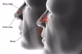 U xơ vòm mũi họng ở nam giới trẻ tuổi: Lành tính nhưng... dễ tử vong
