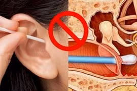 Thủng màng nhĩ vì ngoáy tai