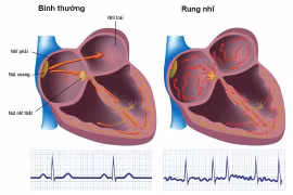  Biến chứng của rung nhĩ