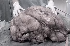 Người đàn ông mang “bụng bầu” u mỡ nặng gần 18kg