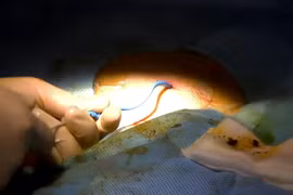 Lấy sỏi gan qua da