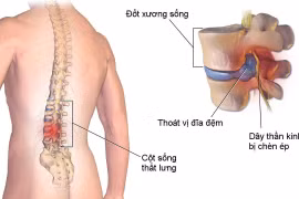 Biến chứng khi đốt nhiệt nội đĩa trị thoát vị đĩa đệm