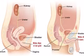 Viêm bàng quang do E.coli đa kháng