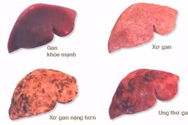 U gan giàu mạch